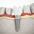 Rodzaje implantów zębów