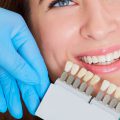 Wybielanie zębów warto zaplanować przez wszczepieniem implantów