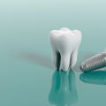 Implanty zębowe - mity i fakty