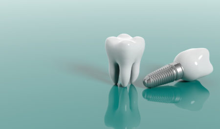 Implanty zębowe - mity i fakty