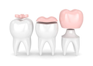 Odbudowa zniszczonego zęba - wypełnienia stomatologiczne i korona